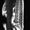 The MRI scan of my collapsed discs...